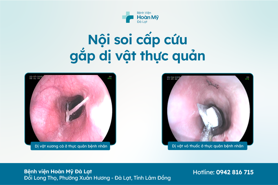Bệnh viện Hoàn Mỹ Đà Lạt nội soi cấp cứu cho 2 trường hợp trung niên nuốt phải dị vật